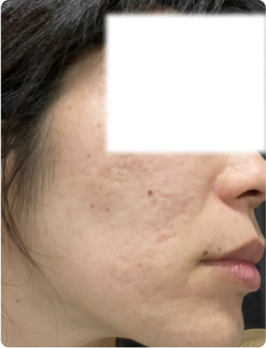 大人ニキビ - 卒業後