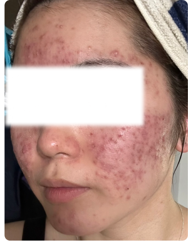 重度ニキビ - 入部時