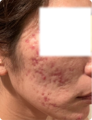 大人ニキビ - 入部時